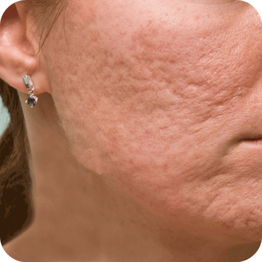 Acne Scar Removal Home Remedy 1.3 Icon
