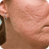 Acne Scar Removal Home Remedy icon