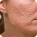 Acne Scar Removal Home Remedy