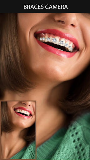 Android application Braces Camera screenshort