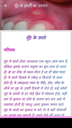 मुँह के छालों का उपचार