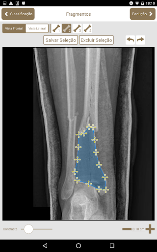 Osteotrauma Screen 3