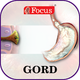 GORD / GERD - An Overview icon