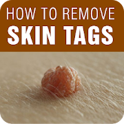 Skin Tag Removal - How to Remove Skin Tags