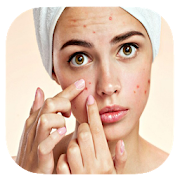 Acne Treatments & Remedies