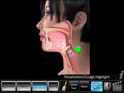 Android application Swallowing Aspiration screenshort
