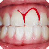 How To Stop Bleeding Gums icon