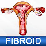 Cover Image of Herunterladen Uterine Fibroid Causes Symptoms Types & Treatment 1.7 APK
