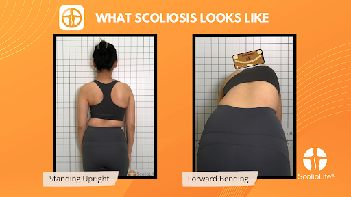 Scoliometer App screenshot 2