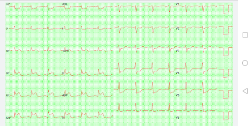 Ecg Screen 3