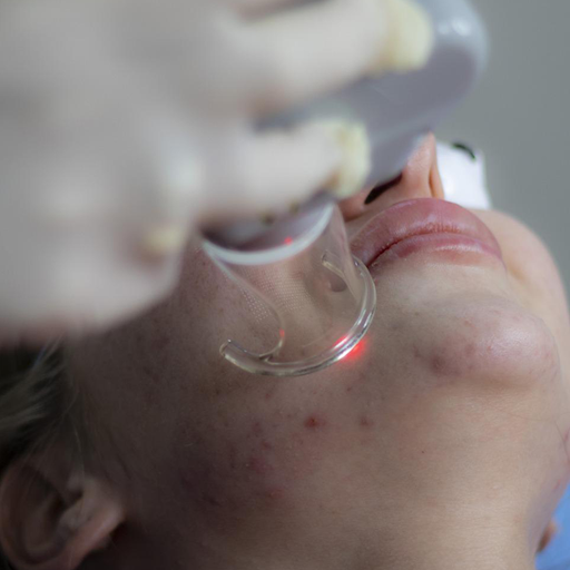 وصفات علاج حب الشباب طبيعيا