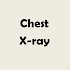 Chest X-Ray