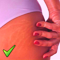 Get rid of STRETCH MARKS Naturally - Home Remedies