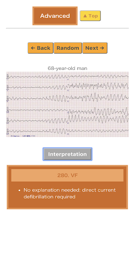 Pocket ECG