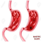 Peptic Ulcer & Treatment