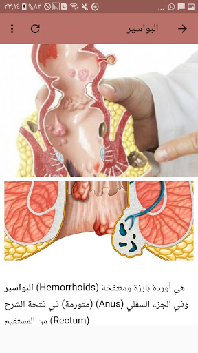 Hemorrhoids causes treatment Screen 3