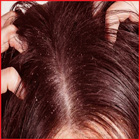 وصفات علاج قشرة الشعر