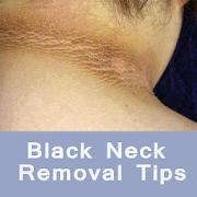 Black Neck Removal Tips - गर्दन के कालेपन का इलाज