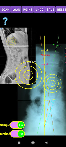 Spinopelvic balance App screenshot 20