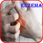 Cover Image of ダウンロード Eczema Causes, Diagnosis, and  APK