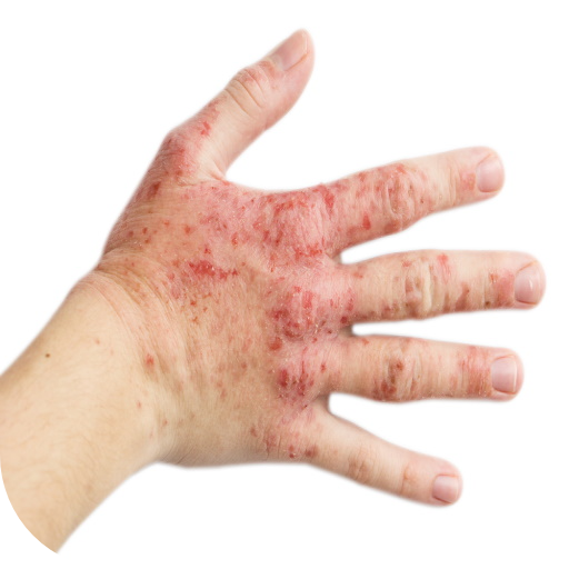 Eczema Disease and Treatment logo