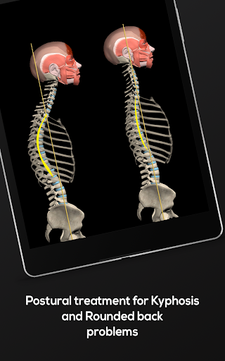 Screenshot of Kyphosis & Rounded Back by M&M