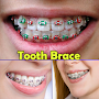 Tooth Brace Ideas