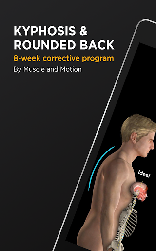 Screenshot of Kyphosis & Rounded Back by M&M