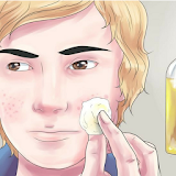 Como eliminar el acné icon