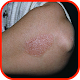 Psoriasis Treatment Download on Windows