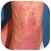 Eczema in the skin