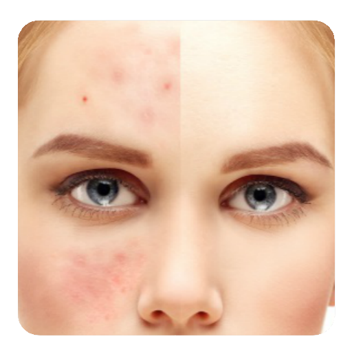 guide to Get rid of Acne  Icon
