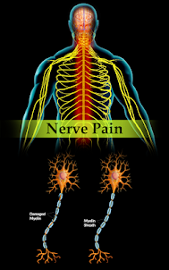 Nerve Pain