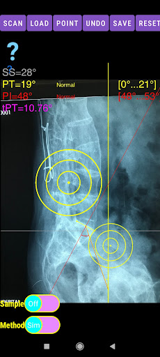 Spinopelvic balance App screenshot 23