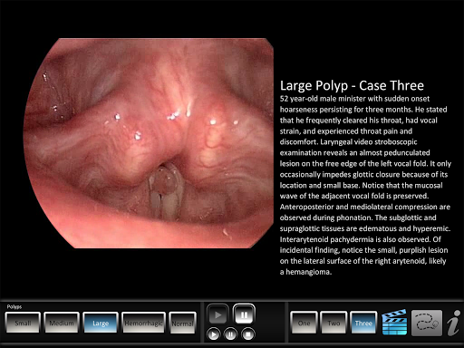 Polyps Screen 3