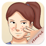 Remove Pimples Guide icon