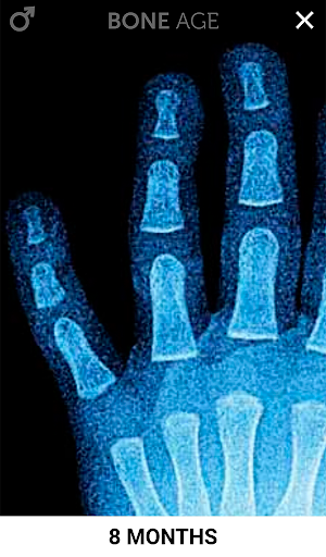 Bone Age Lite