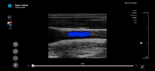 Android application SONON X Ultrasound App screenshort