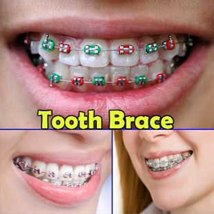 Tooth Brace Ideas 2.6 APK + Mod (Free purchase) for Android