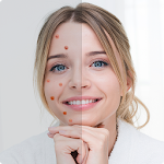 Cover Image of Baixar Remove Acne from Face 3.0 APK