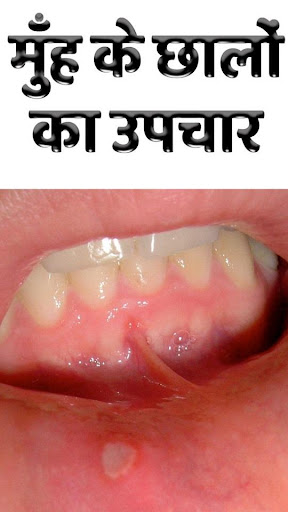मुँह के छालों का उपचार