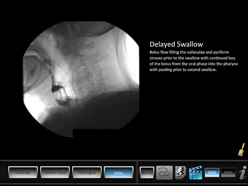 Swallowing Residue Screen 3
