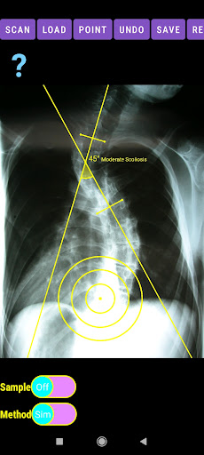 Cobb Angle App Screen 2