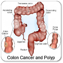 Icon image Colon Cancer