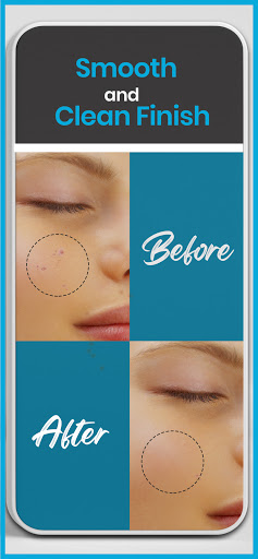 Pimple remover - Acne eraser Screen 3