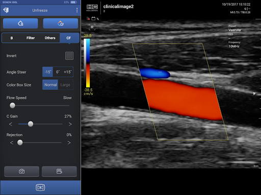SONON Ultrasound App Screen 3