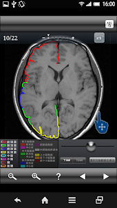 断面図ウォーカー脳MRI