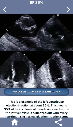 HEART EJECTION FRACTION Screen 3