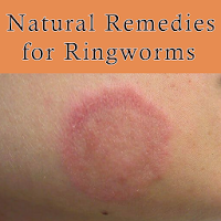 Natural Remedies for Ringworms