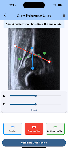 Hip Angle Graf Ultrasound calc